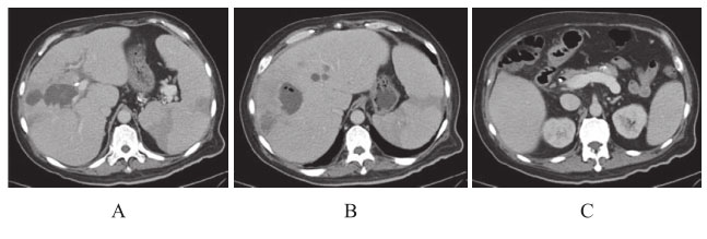 图4 腹部增强CT（第三次入院）.jpg